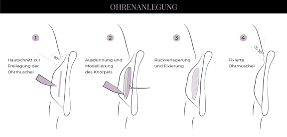 Grafik Ohren anlegen, Schönheitschirurgie in Hamburg, Dr. med. Alaleh Jamshidi